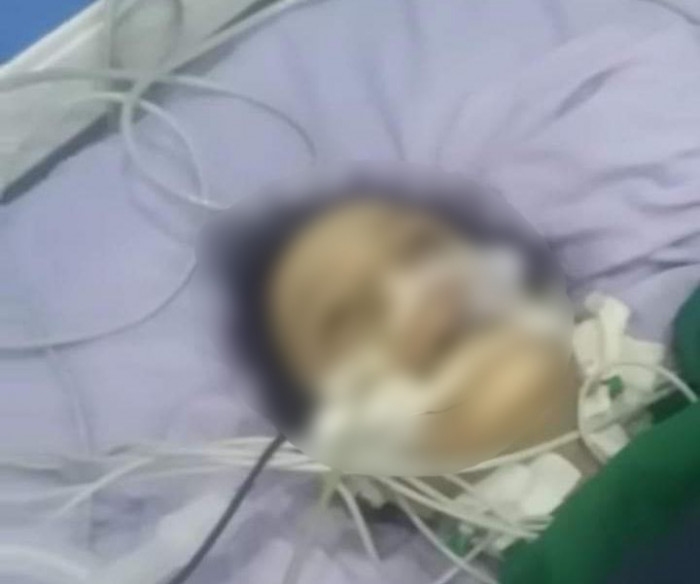 ولادة في مستشفى في إب تنتهي بانفجار في الرحم والأمعاء