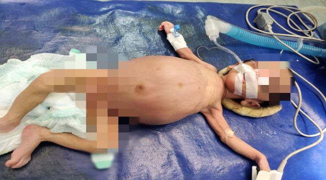 نجاح عملية نادرة وغريبة لمولود طفلة داخل بطنها مكونات طفل آخر بحضرموت