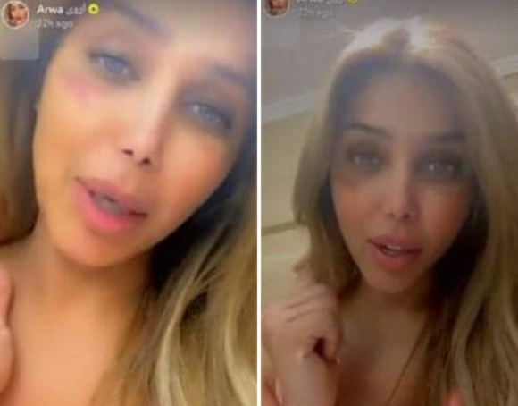 الفنانة اليمنية الشهيرة اروى تتهم زوجها بضربها وحرق وجهها .. شاهد كيف بدا شكلها ! صور